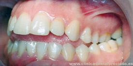 Dentadura. Vista lateral izquierda antes del tratamiento.