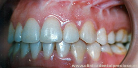 Dentadura. Vista lateral izquierda despues del tratamiento.