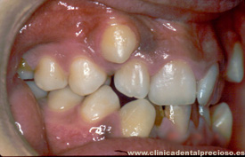 Dentadura. Vista lateral derecha antes del tratamiento.