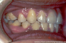 Dentadura. Vista lateral derecha despues del tratamiento.