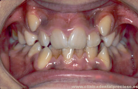 Dentadura. Vista central antes del tratamiento.