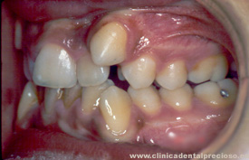 Dentadura. Vista lateral izquierda antes del tratamiento.