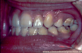 Dentadura. Vista lateral izquierda despues del tratamiento.