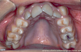Dentadura. Vista arcada superior antes del tratamiento.