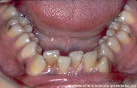 Dentadura. Vista arcada inferior antes del tratamiento.