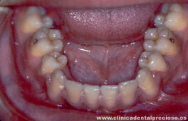 Dentadura. Vista arcada inferior despues del tratamiento.